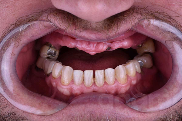Восстановление зубного ряда верхней челюсти с помощью имплантации All-on-4