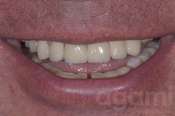 Имплантация и протезирование зубoв коронками