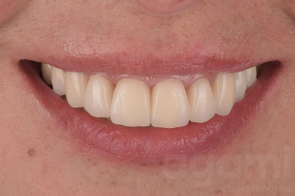 Протезирование зубов на верхней челюсти в зоне улыбки