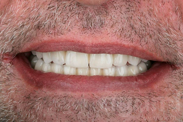 Тотальное восстановление зубных рядов