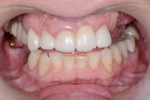 Восстановление зубных рядов верхней и нижней челюсти