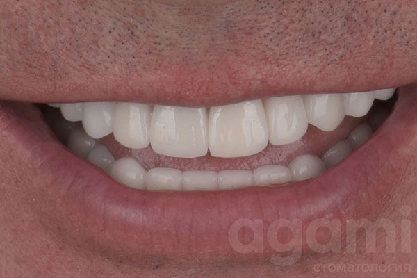 Имплантация и протезирование зубoв коронками