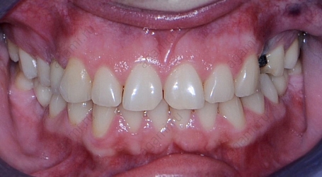 Восстановление эстетики фронтальных зубов при помощи виниров Emax
