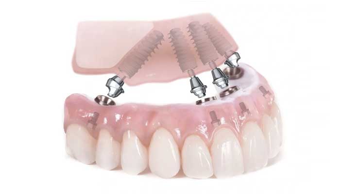 Как правильно выбрать стоматологическую клинику для протезирования зубов на 4 имплантах