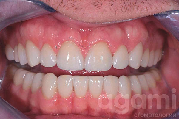 Восстановление при патологической стираемости зубов
