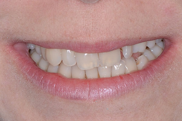 Восстановление верхнего зубного ряда при помощи виниров на рефракторе