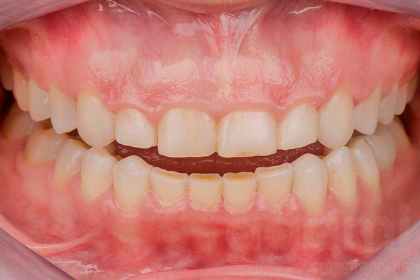 Коррекция улыбки при помощи имплантации и протезирования винирами