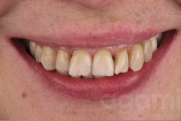 Протезирование зубов на верхней челюсти в зоне улыбки