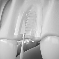 Наращивание костной ткани для имплантации SonicWeld Rx® Dental
