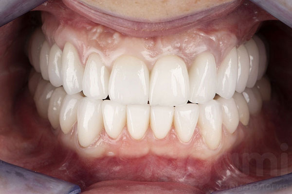 Восстановление зубных рядов верхней и нижней челюсти