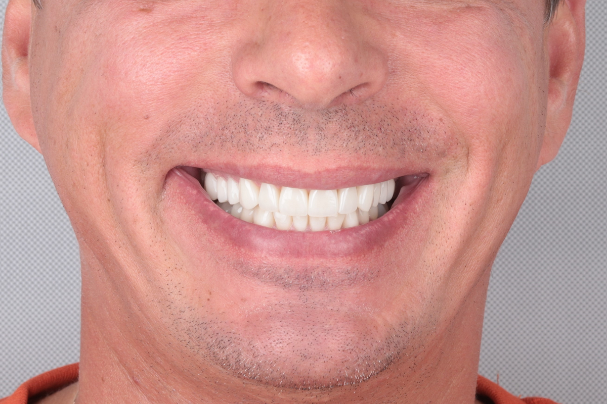 Имплантация и протезирование зубов