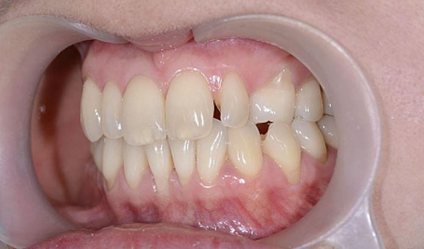 Восстановление верхнего зубного ряда при помощи виниров на рефракторе