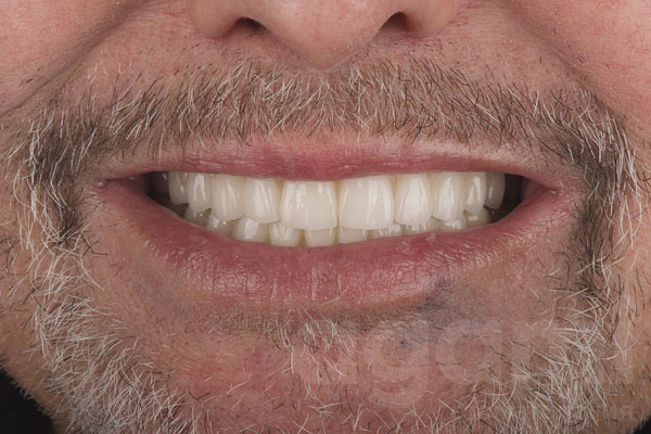 Восстановление зубов верхней и нижней челюсти на имплантатах