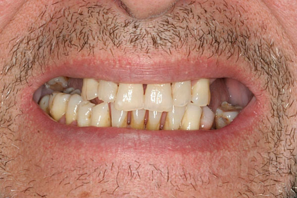 Реставрация зоны улыбки и восстановление жевательных зубов