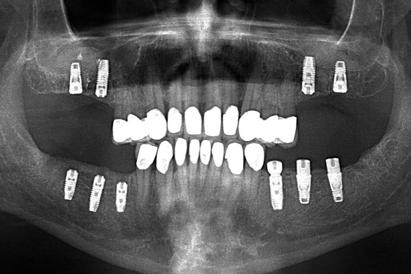Имплантация зубов (рентген)