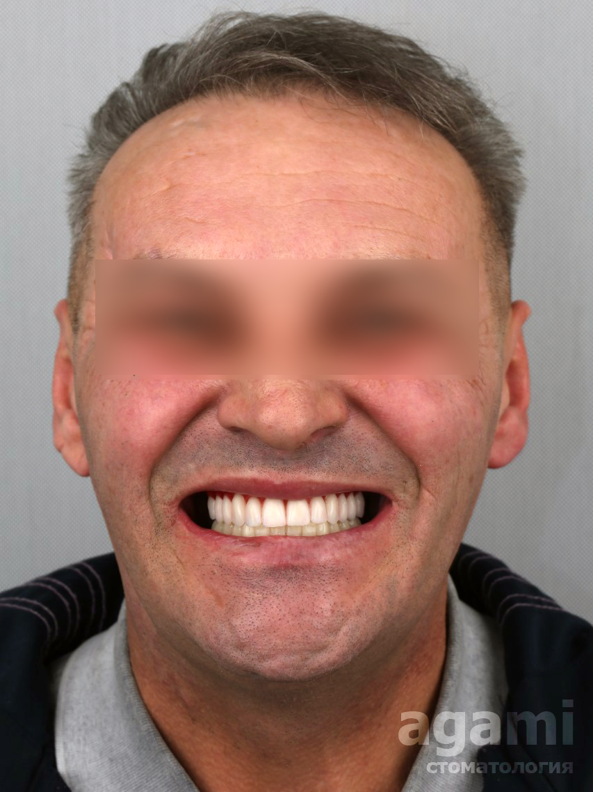Имплантация зубов All-on-6