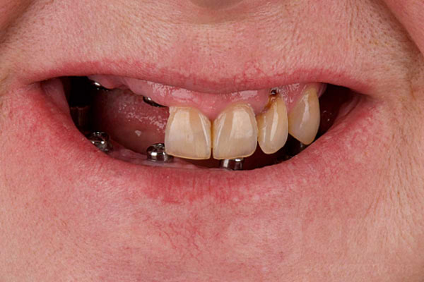 Тотальное восстановление улыбки с помощью имплантации зубов